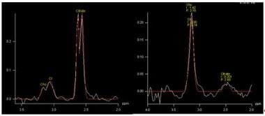 Proton magnetic resonance spectrum in a normal vox