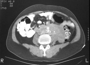 CT scan in a 62-year-old man shows a soft-tissue a