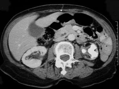 Contrast-enhanced CT scan demonstrates an opaque s