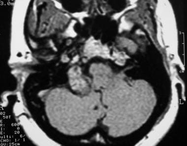 Glomus jugulare tumor. Axial contrast-enhanced T1-