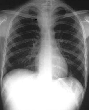 Standard posteroanterior chest radiograph in the s