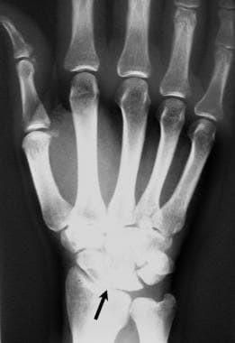 Plain radiograph of the right wrist of a man demon