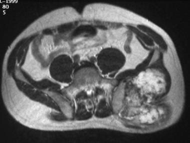 T2-weighted axial MRI of the pelvis demonstrates a