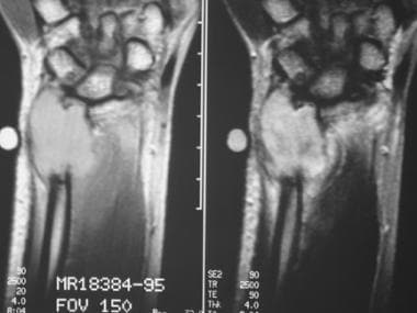 T2-weighted coronal MRIs of the wrist show a giant