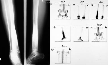 Osteomyelitis, chronic. Radiograph (left) and isot
