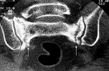 Coronal CT of the sacrum demonstrates fractures (a
