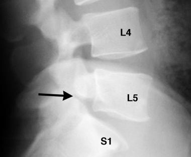 Spondylolisthesis. Straight lateral radiograph of 