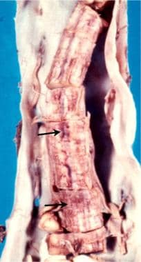 Thoracic spine trauma. Anterior view of multiple s