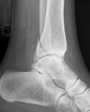 Lateral radiograph from a 31-year-old woman with a