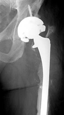 Long stem revision bypassing proximal femoral defe