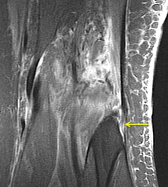 anterior cruciate ligament mri