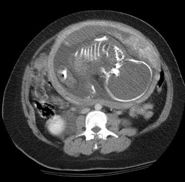 Placental ischemia: Contrast-enhanced CT image thr