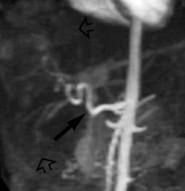 Contrast enhanced 3-dimensional MR angiogram (grad