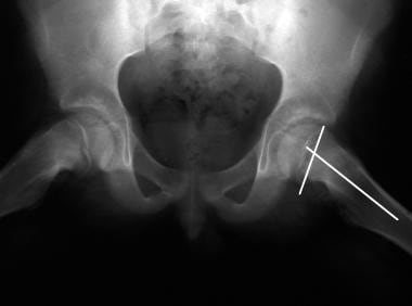 Slipped capital femoral epiphysis. Frog-leg pelvic