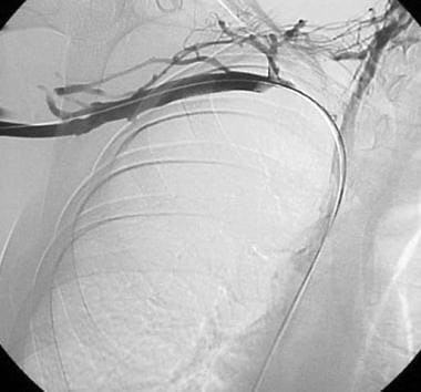 A venogram of a 20-year-old woman with right arm s