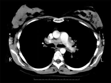 Stage II sarcoidosis. Courtesy of Anthony Notino, 