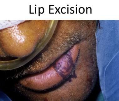 Planned wedge excision of lower lip. 