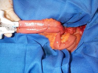 Surgical Treatment of Ulcerative Colitis: Background, Indications for  Surgery, Contraindications for Surgery