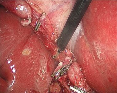 Laparoscopic cholecystectomy. Use of hook to devel