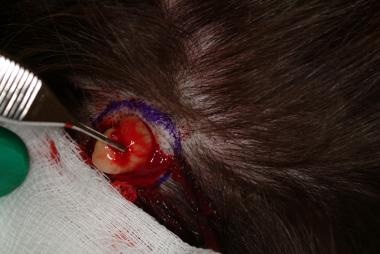 Surgical removal of an intact pilar cyst through a