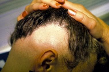 Ophiasis pattern of alopecia areata. 