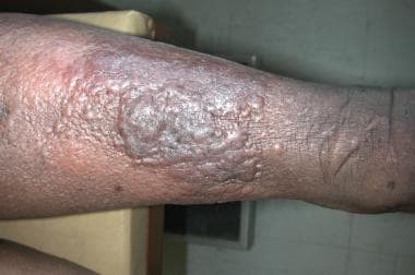 A) A 67-year-old woman represented varicose veins as well as edema