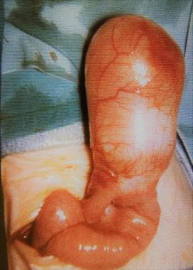 Intestinal obstruction in the newborn. An enteric 