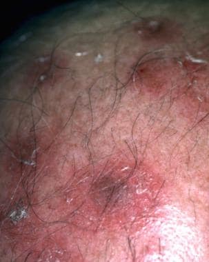Close-up of a scalp lesion. Courtesy of Alexa F Bo