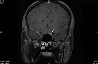 Gadolinium-enhanced, T1-weighted image showing enh