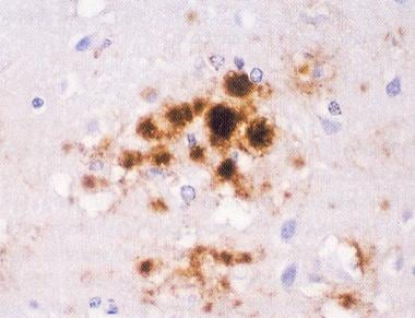 Immunocytochemistry for prion protein (PrP) shows 