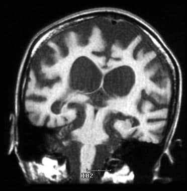 Coronal T1-weighted MRI image of the brain of a 47