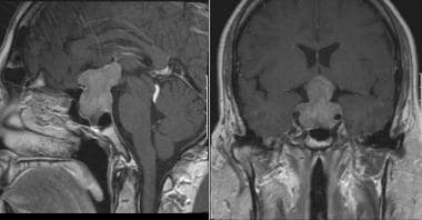 Magnetic resonance imaging (MRI) scan of pituitary
