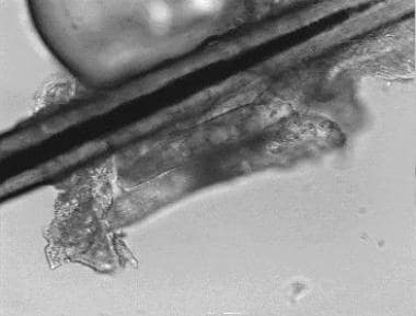 Demodex along the shaft of the cilia (higher magni