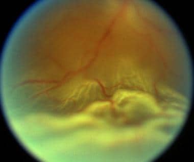 An acute rhegmatogenous retinal detachment that ma
