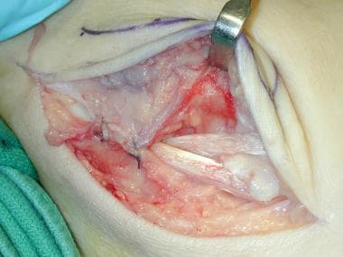 Partial repair of peroneal tendon sheath. 