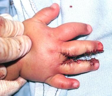 Hand of 1-year-old patient with complete simple sy