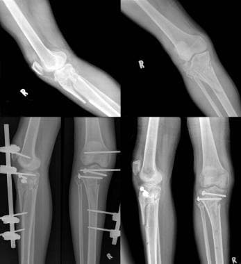 Type VI tibial plateau fracture undergoing biological fixation of the later...