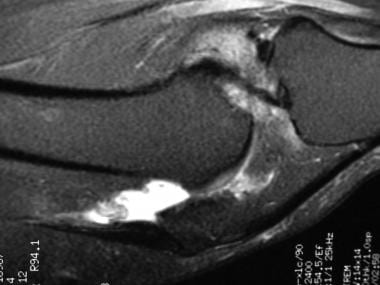 Sagittal T2-weighted MRI of patient with synovial 