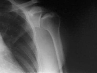 Shoulder osteonecrosis stage IV disease. 