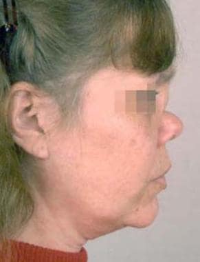 Woman with a subtype of midline granulomatous dise