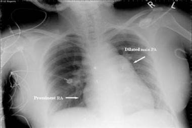 Eisenmenger Syndrome. This radiograph reveals an e