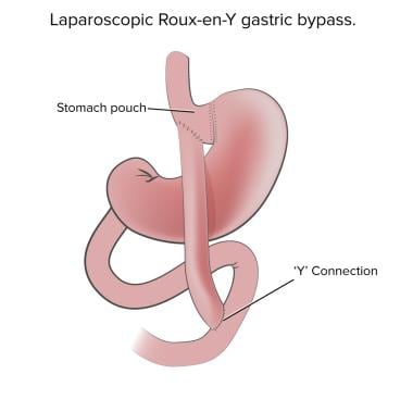 Port Placement for Gastric Bypass -SAGES Image Library