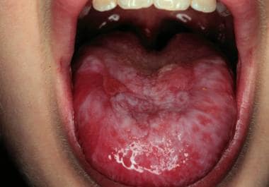 Oral leukoplakia in dyskeratosis congenita. 