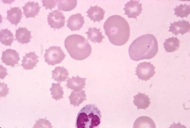 Acanthocytes with target cells in a patient with a