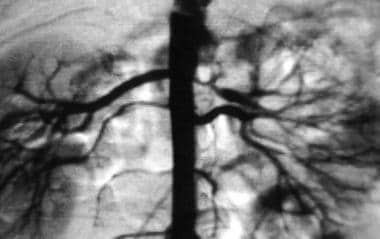 Close-up view of aortogram of 4-year-old child. St