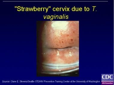
T vaginalis can have a characteristic "frothy" gr