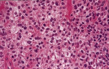 Clear cell ependymoma. Round cells with cytoplasmi