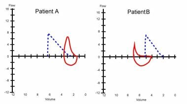 Flow volume curve of a patient with emphysema show