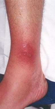 Lyme disease. The rash on the ankle seen in this p