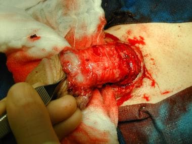 Penile amputation after replantation. 